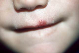 Cantharidin is a natural toxin extracted from blister beetles which is used to warts and molluscum contagiosum. Cantharidin is a natural toxin extracted from blister beetles which is used to warts and molluscum contagiosum.