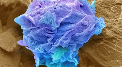 Gentian Violet Induces Apoptosis and Proliferation of Cutaneous T-Cell Lymphoma Gentian Violet Induces Apoptosis and Proliferation of Cutaneous T-Cell Lymphoma