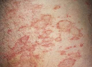 Dupilumab suppressed systemic inflammatory biomarkers including, CCL17, CCL18, periostin, and total and allergen-specific IgEs. Dupilumab suppressed systemic inflammatory biomarkers including, CCL17, CCL18, periostin, and total and allergen-specific IgEs.