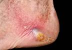Skin Disease and Metabolic Syndrome: Early Warning Signs of a Greater Problem Skin Disease and Metabolic Syndrome: Early Warning Signs of a Greater Problem