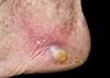 Skin Disease and Metabolic Syndrome: Early Warning Signs of a Greater Problem Skin Disease and Metabolic Syndrome: Early Warning Signs of a Greater Problem