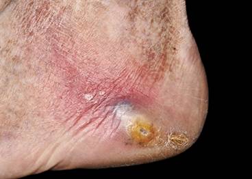 Skin Disease and Metabolic Syndrome: Early Warning Signs of a Greater Problem Skin Disease and Metabolic Syndrome: Early Warning Signs of a Greater Problem