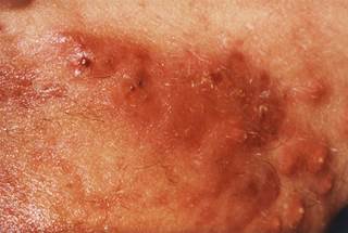 Some mild to moderate adverse events were associated with the treatment regimens. Some mild to moderate adverse events were associated with the treatment regimens.