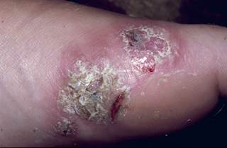 More research is needed to better understand the pathophysiologic mechanisms that result in increased risk for infection among individuals with psoriasis. More research is needed to better understand the pathophysiologic mechanisms that result in increased risk for infection among individuals with psoriasis.
