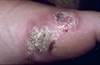 Managing Infection Risk in Psoriasis: Expert Q&A Managing Infection Risk in Psoriasis: Expert Q&A