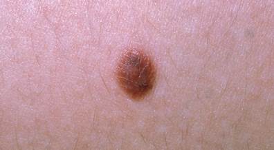 Risk for Nevus Development in Children Aged 3 to 16 Years Risk for Nevus Development in Children Aged 3 to 16 Years