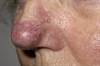 Alternative Therapies for Rosacea: Seeking Safe Advice for Frustrated Patients Alternative Therapies for Rosacea: Seeking Safe Advice for Frustrated Patients