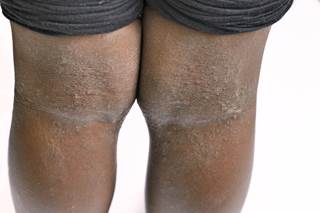 Investigators sought to characterize phenotypic variations in patients with atopic dermatitis who were African American and European American. Investigators sought to characterize phenotypic variations in patients with atopic dermatitis who were African American and European American.