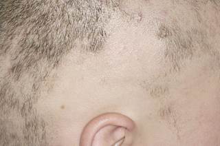 Complete or near-complete hair regrowth occurred in 5 patients, with a 98% improvement in the Severity of Alopecia Tool score. Complete or near-complete hair regrowth occurred in 5 patients, with a 98% improvement in the Severity of Alopecia Tool score.