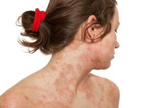 Antidepressant use was numerically greater among adults and children with atopic dermatitis vs those without. Antidepressant use was numerically greater among adults and children with atopic dermatitis vs those without.