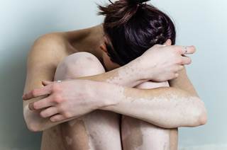 Study results suggest that vitiligo is associated with an increase in primary hospitalizations for several mental health conditions. Study results suggest that vitiligo is associated with an increase in primary hospitalizations for several mental health conditions.