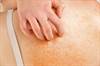 Upadacitinib Improves Pruritus in Moderate to Severe Atopic Dermatitis Upadacitinib Improves Pruritus in Moderate to Severe Atopic Dermatitis