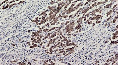 Possible Predictors of Sentinel Lymph Node Positivity in Thin Melanomas Possible Predictors of Sentinel Lymph Node Positivity in Thin Melanomas