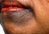 Common Skin Conditions in People of Color: Identification and Treatment Common Skin Conditions in People of Color: Identification and Treatment