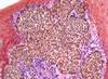 Increased Risk for Cancer Observed in Abatacept-Treated Rheumatoid Arthritis Increased Risk for Cancer Observed in Abatacept-Treated Rheumatoid Arthritis