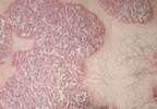 Psoriasis Associated With Increased CV Intervention Risk in Patients With Hypertension Psoriasis Associated With Increased CV Intervention Risk in Patients With Hypertension