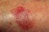 Topical Hydrogen Peroxide May Be Most Effective for Facial Seborrheic Keratoses Topical Hydrogen Peroxide May Be Most Effective for Facial Seborrheic Keratoses