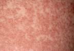Review Shares Best Practices for Evaluating Penicillin Allergy Review Shares Best Practices for Evaluating Penicillin Allergy