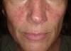 Skeletal Muscle Mass May Be Protective Against Rosacea Severity Skeletal Muscle Mass May Be Protective Against Rosacea Severity