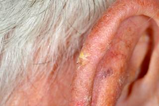 The use of ablative laser-assisted photodynamic therapy may provide an effective treatment option for actinic keratosis. The use of ablative laser-assisted photodynamic therapy may provide an effective treatment option for actinic keratosis.