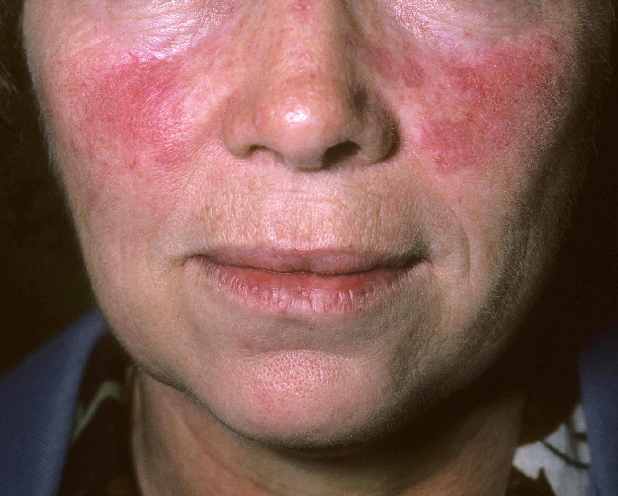 Why take low dose aspirin rosacea