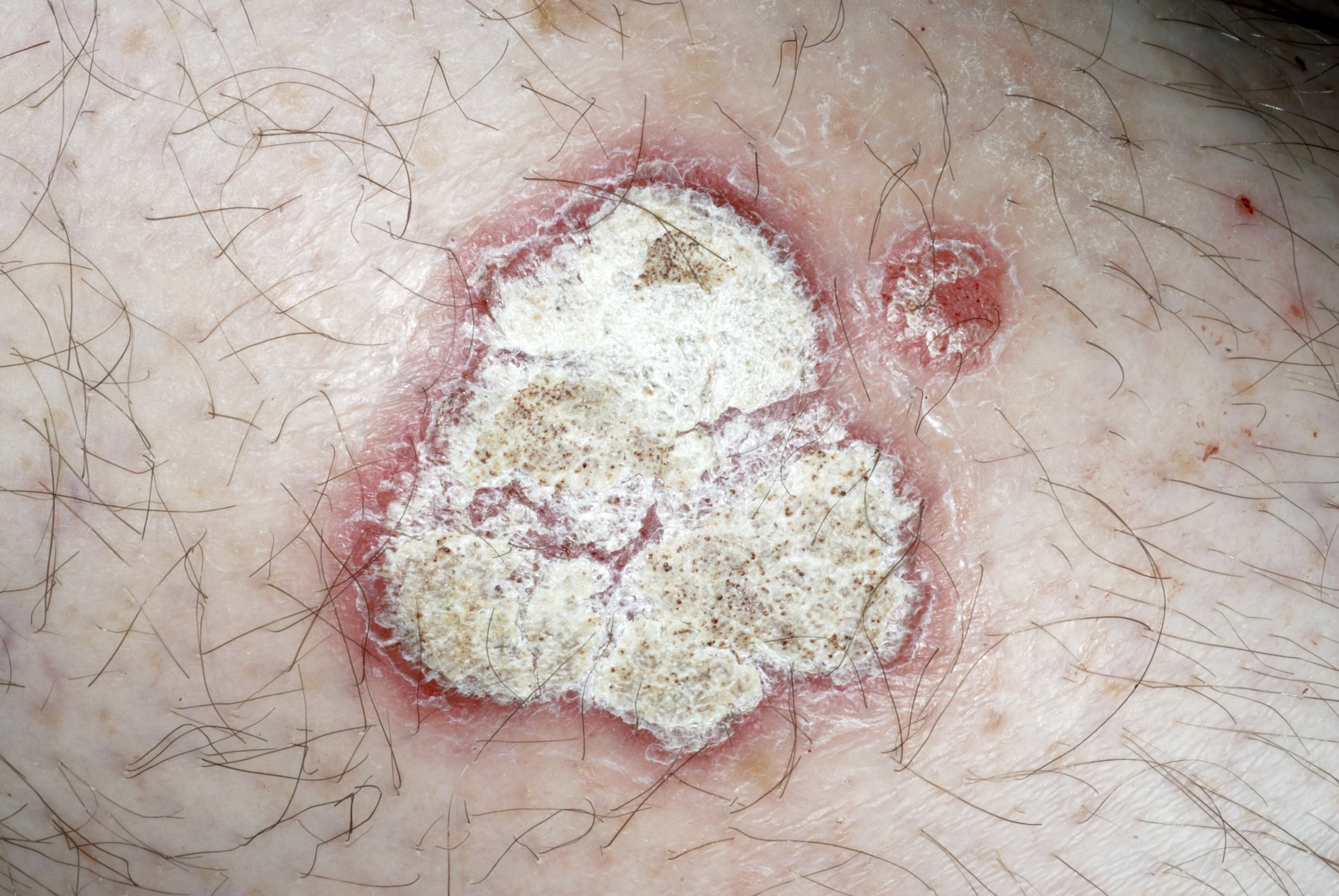 Ixekizumab Deemed Safe, Effective for Plaque Psoriasis in