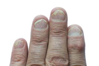 The ability of secukinumab vs placebo to clear nail psoriasis was evaluated using the Nail Psoriasis Severity Index.
