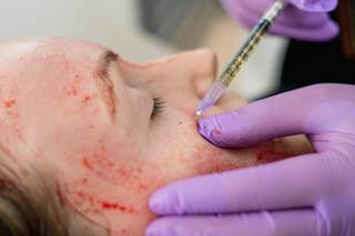 Participants noted improvements in facial texture and wrinkles after injections of platelet-rich plasma. 