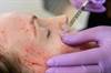 PRP May Reduce Visible Signs of Photoaging in Facial Rejuvenation PRP May Reduce Visible Signs of Photoaging in Facial Rejuvenation