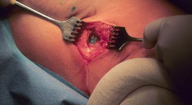 Nomogram Predicts Melanoma Recurrence Risk After Negative Sentinel Node Biopsy Nomogram Predicts Melanoma Recurrence Risk After Negative Sentinel Node Biopsy