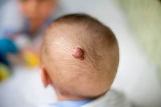 The American Academy of Pediatrics has developed its first guideline for the management of infantile hemangiomas. The American Academy of Pediatrics has developed its first guideline for the management of infantile hemangiomas.