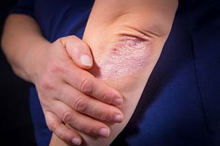 The investigators sought to compare the efficacy and safety of methotrexate to treat psoriasis in patients with and without psoriatic arthritis.