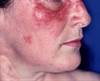 B-Cell Depletion Therapy With Rituximab Effective for Cutaneous Lupus Erythematosus B-Cell Depletion Therapy With Rituximab Effective for Cutaneous Lupus Erythematosus
