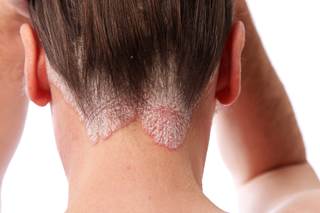 Depending on the definition used, there are large variations in the proportion of patients identified as having moderate-to-severe psoriasis. Depending on the definition used, there are large variations in the proportion of patients identified as having moderate-to-severe psoriasis.