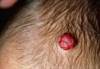 Interventions for Infantile Hemangiomas: Which Are Effective? Interventions for Infantile Hemangiomas: Which Are Effective?