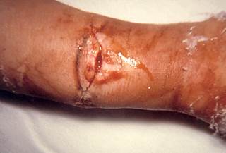 Photo Credit: US Centers for Disease Control and Prevention Photo Credit: US Centers for Disease Control and Prevention