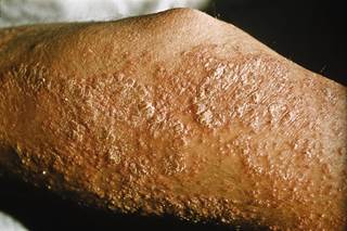 Acute skin manifestations correlated with axial disease and were more common among young participants and those with higher body mass index. <i>Photo Credit: BSIP/Science Source</i>