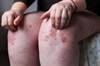 Clinical Challenge: Addressing Psoriasis and Comorbid Obesity Clinical Challenge: Addressing Psoriasis and Comorbid Obesity