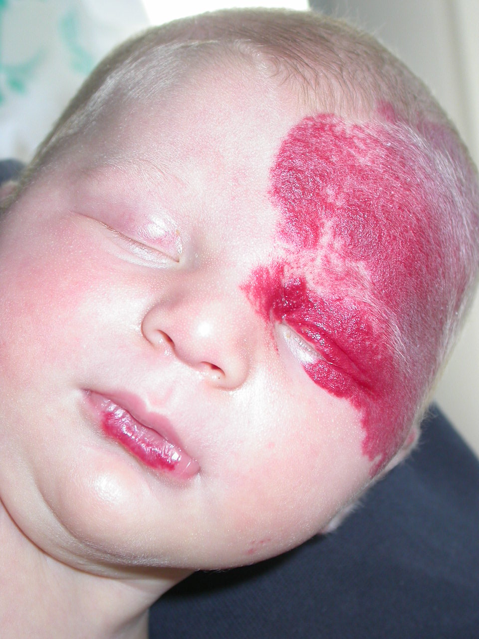 Hemangiomas (infantile hemangiomas, common hemangiomas, strawberry