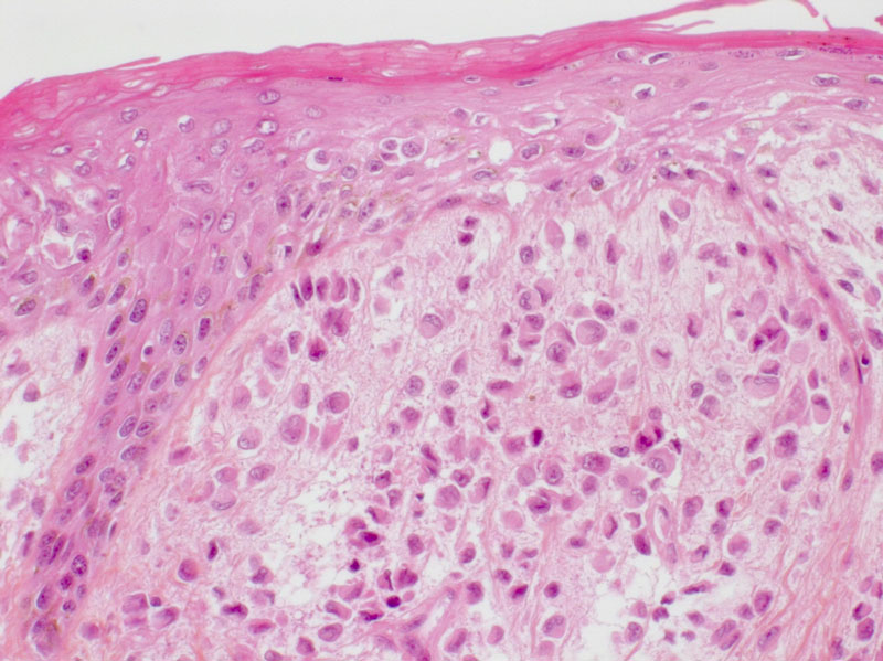 Langerhans Cell Histiocytosis (all variants: Hashimoto-Pritzker disease ...