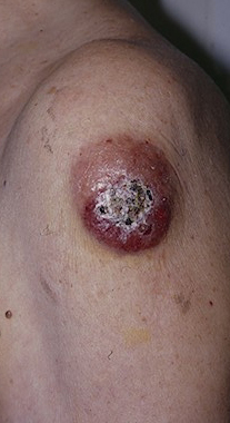 Leukemia Cutis (Leukemia specific skin lesions, myelosarcoma