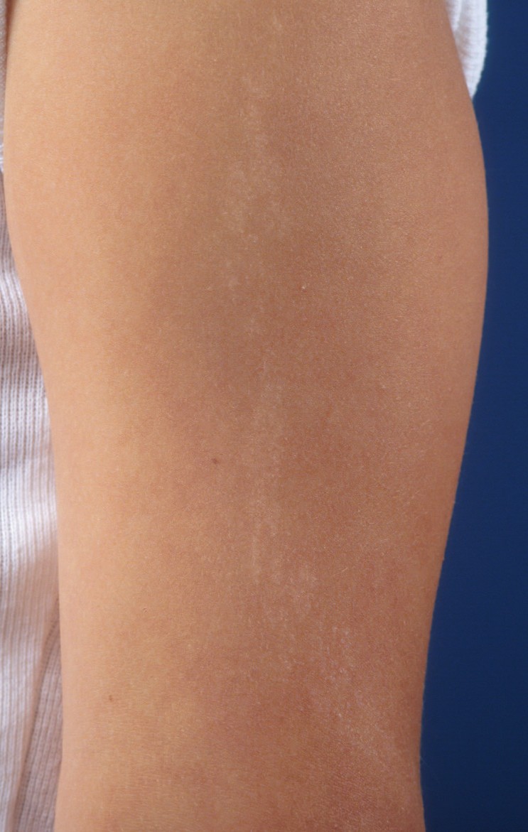 How to treat lichen in children How to treat lichen in children