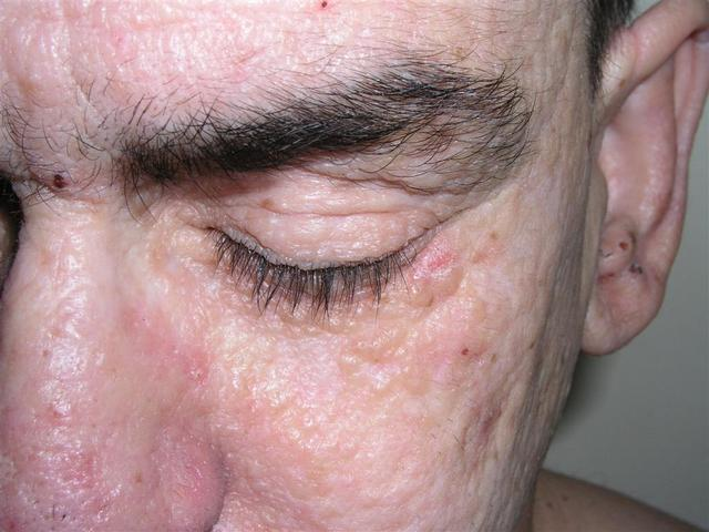 Lipoid Proteinosis (Urbach-Wiethe disease, hyalinosis cutis et mucosae