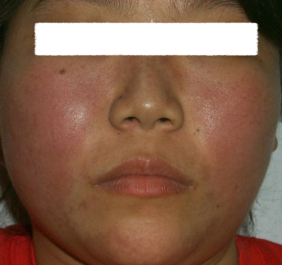 Systemic Lupus Erythematosus (SLE)