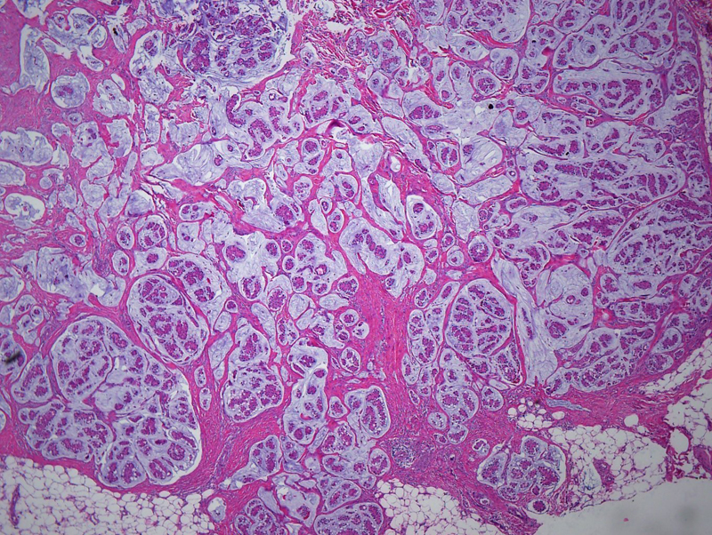 Mucinous Carcinoma