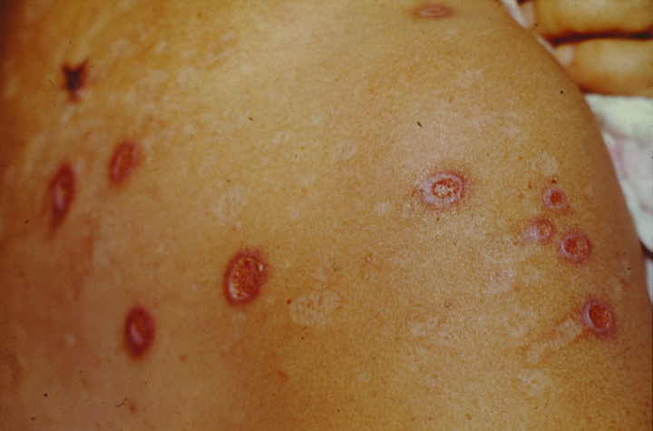 SEARCH AND BUY THIS PRODUCT Neurotic Excoriations (Skin-picking Disorder)