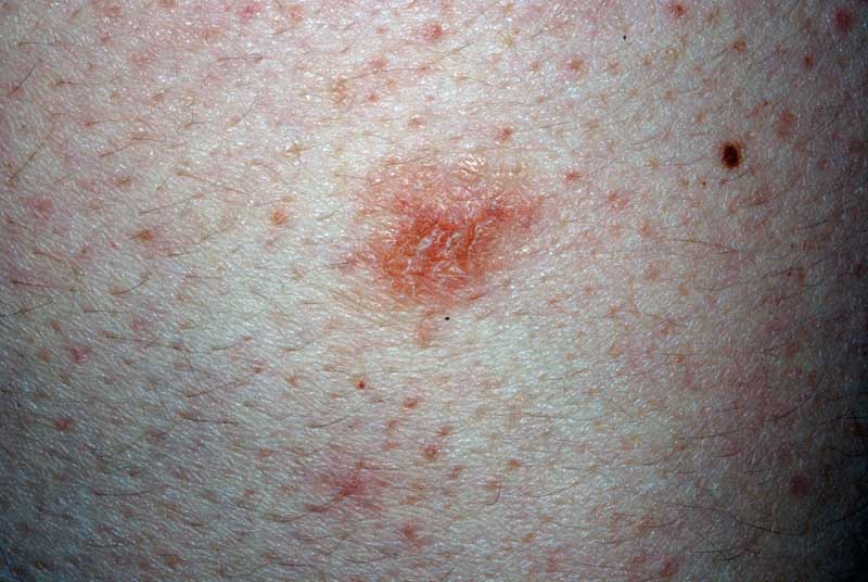 Nummular dermatitis (nummular eczema)