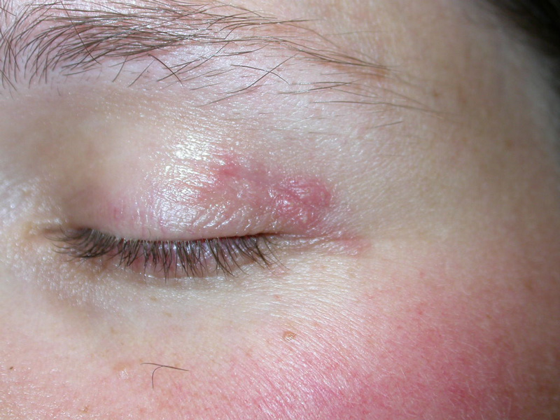 herpes simplex eyelid dermatitis