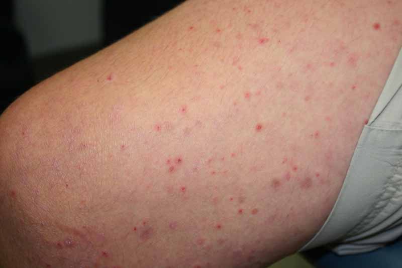 pityriasis-lichenoides-chronica