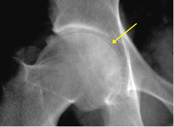 Pseudogout (Calcium Phyrophosphate Deposition Disease)